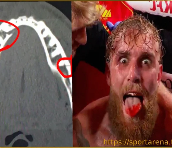 Джейк Пол рассказал о двойном переломе челюсти и сроках своего возвращения в бокс